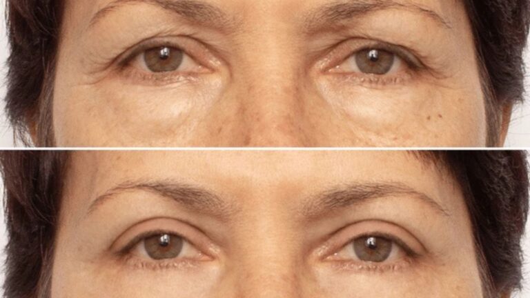 Botox and Anti-Aging: How Long Can It Keep Wrinkles at Bay?